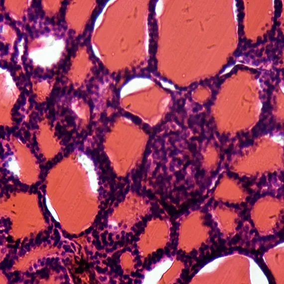 Microscopic view of thyroid gland tissue showing pink colloid-filled follicles surrounded by dark purple follicular cells.